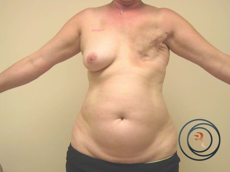 Before — Breast Reconstruction