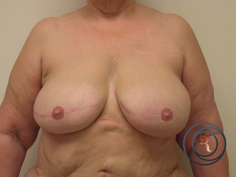 After — Breast Reconstruction