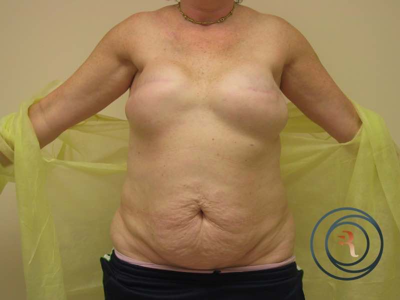 Before — Breast Reconstruction