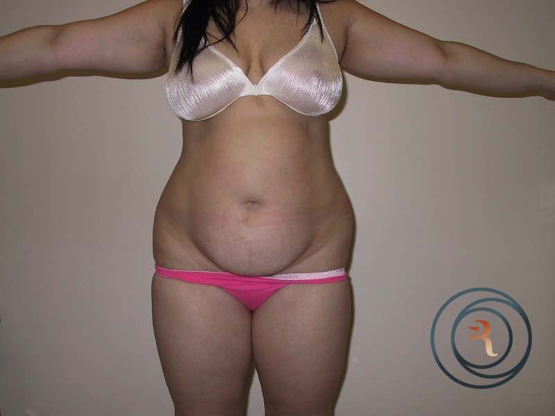 Liposuction before