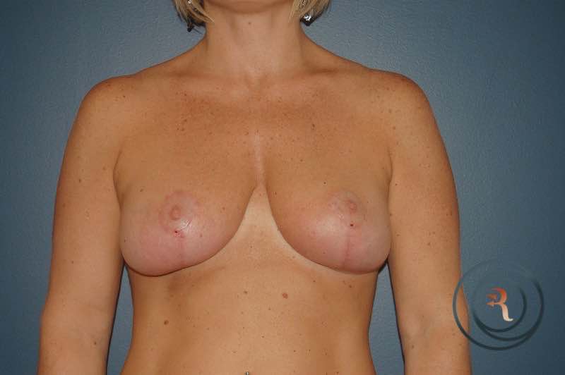 After — Breast Lift with Auto-Augmentation