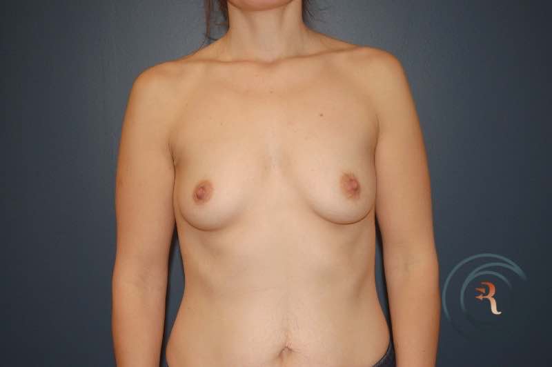 Before — Breast Augmentation