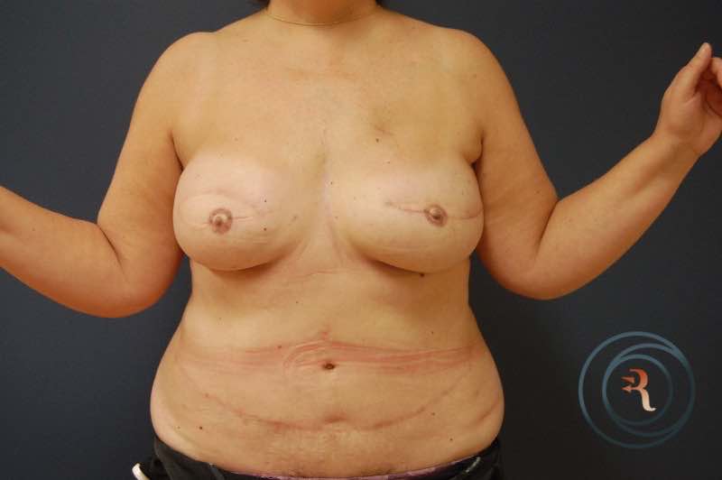 After — Breast Reconstruction