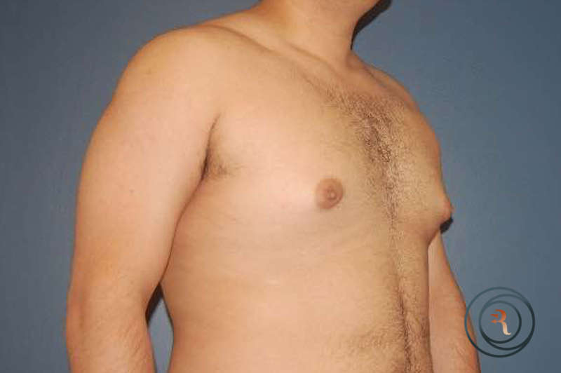 Before — Gynecomastia (Male Breast Reduction)