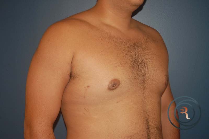 After — Gynecomastia (Male Breast Reduction)