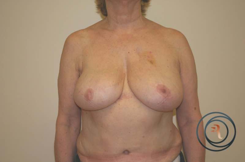 After — Breast Reconstruction