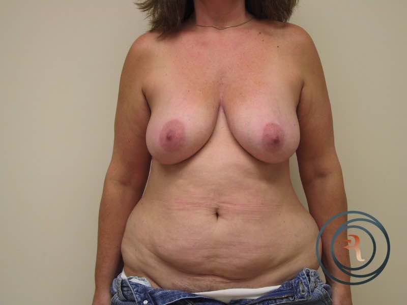 Before — Breast Reconstruction