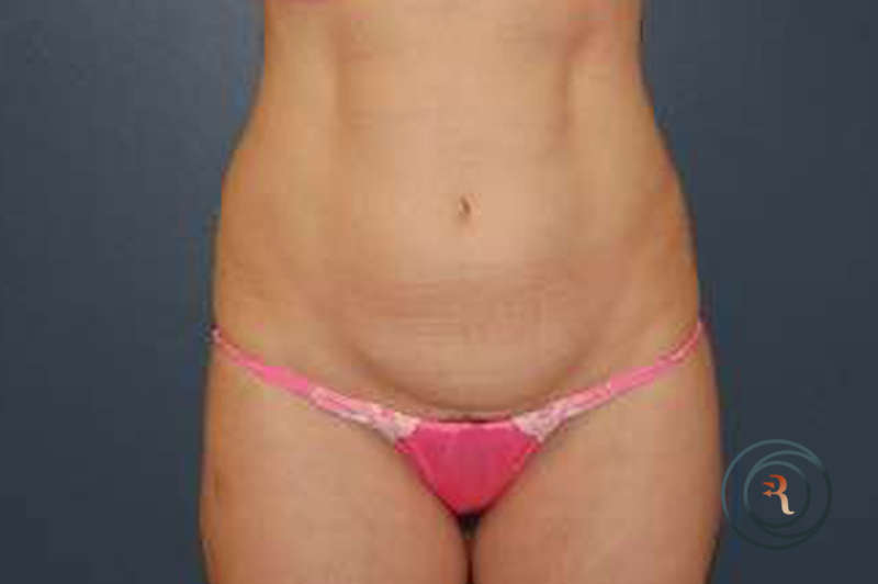 Before — Liposuction, Abdominoplasty