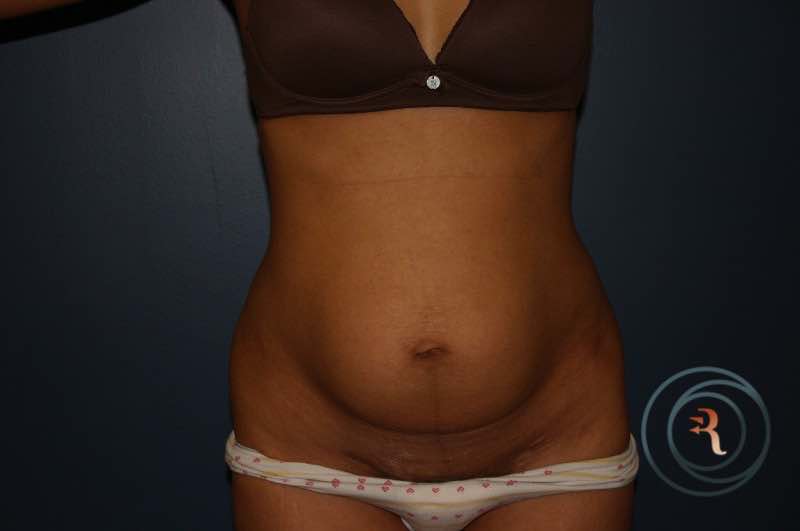 Before — Abdominoplasty