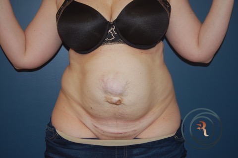 Before — Abdominoplasty and Repair of Ventral Hernia