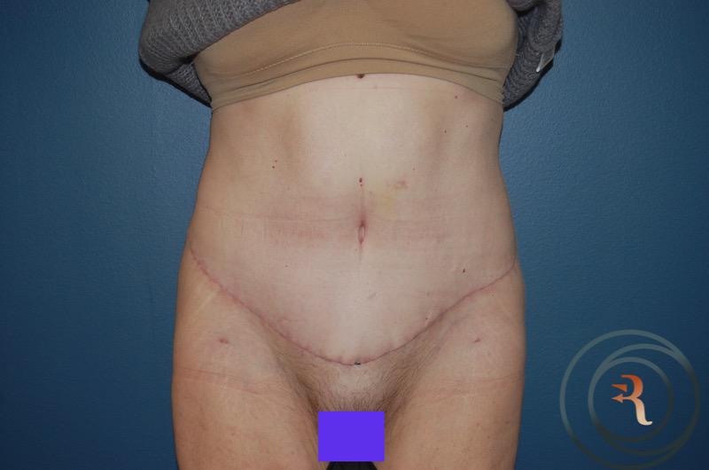 After — Abdominoplasty