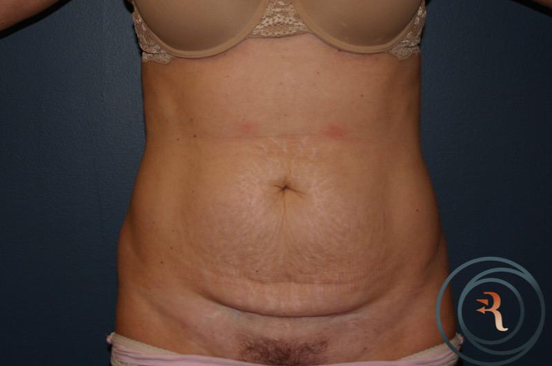 Before — Abdominoplasty