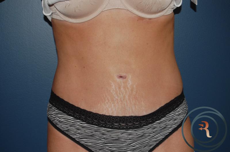After — Abdominoplasty
