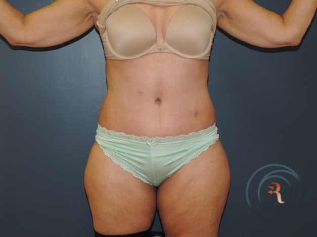 After — Abdominoplasty