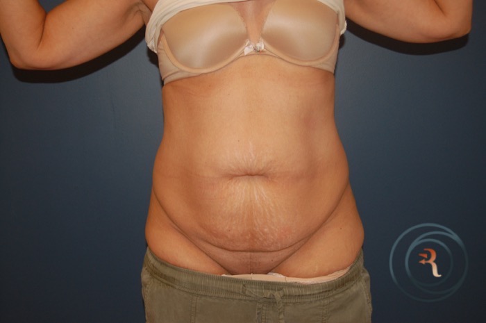 Before — Abdominoplasty