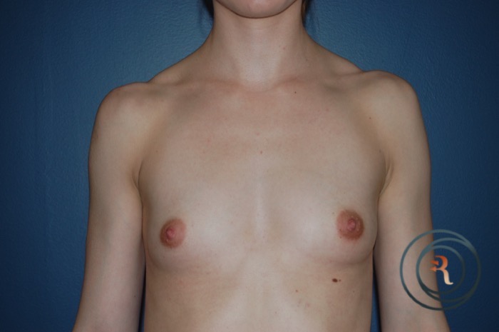 Before — Breast Augmentation