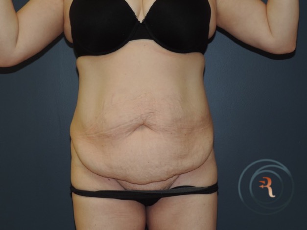 Before — Abdominoplasty